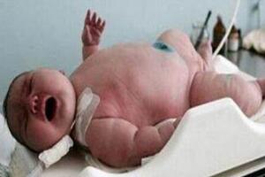 世界上最大的婴儿,出生体重36斤(母亲体重544斤)