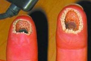 超恶心的手指图片：空手指(手上全是洞密集症慎入)