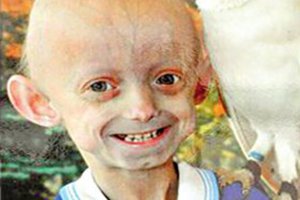 世界十大奇怪的病 就連大笑都可能會導致死亡
